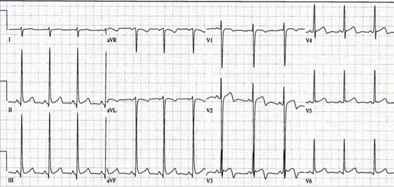 emDOCs.net – Emergency Medicine EducationWellens' Syndrome - emDOCs.net