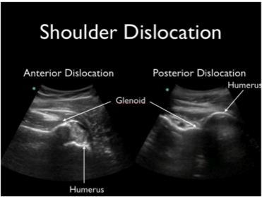 Examples of shoulder dislocations