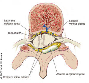 Epidural steroid injection failure