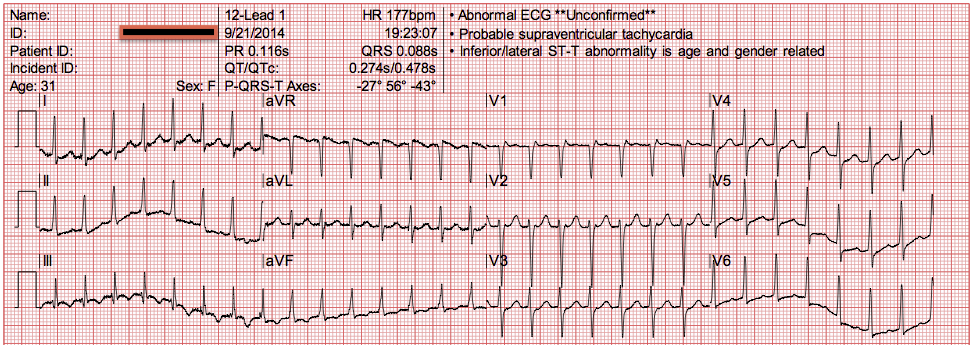 ekg5