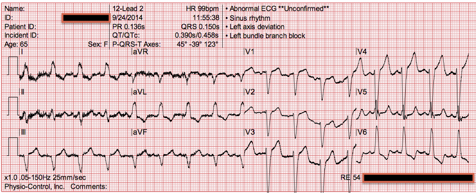 Image result for Image EKG