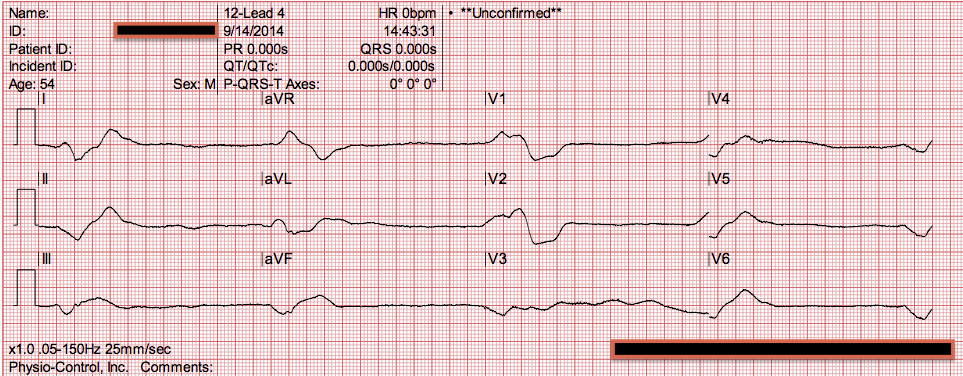 pulseless electrical activity pulseless electrical activity