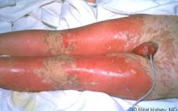 Dermatologic Manifestations of Stevens-Johnson Syndrome ...