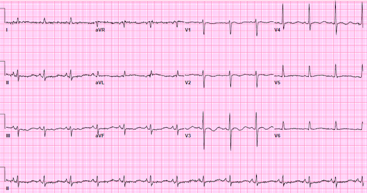ekg1