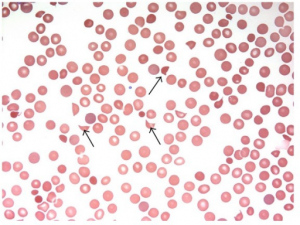 thrombocytopenia smear II