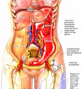 hematoma w: femoral nerve involvement