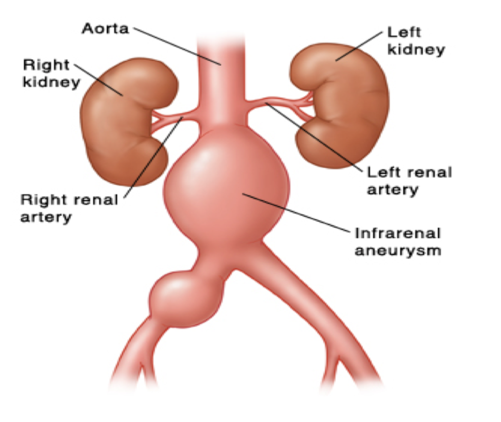 Saccular Aneurysm Of The Infrarenal Abdominal Aorta