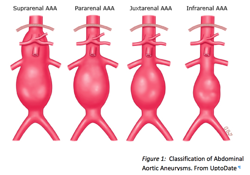 Saccular Aneurysm Of The Infrarenal Abdominal Aorta