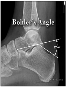 Bohler's angle