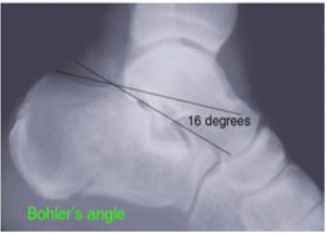 Bohler's angle II