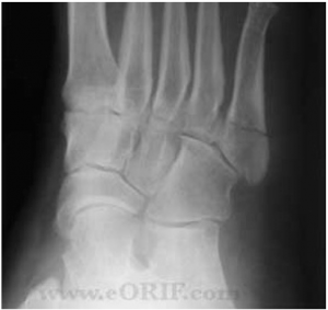 Jones fracture