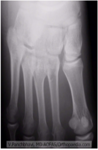 Lisfranc fracture