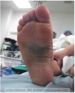 Lisfranc fracture II