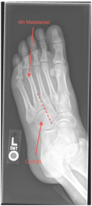 Lisfranc fracture III