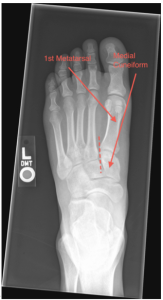 Lisfranc fracture IV