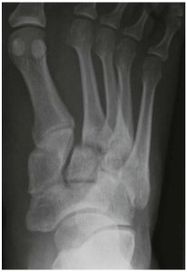 Tarsometatarsal joints