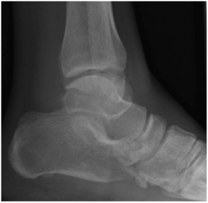 anterior process calcaneal fracture