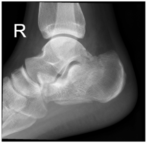 calcaneus injury