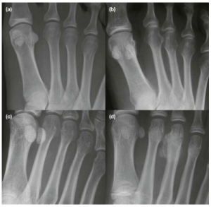 stress fracture II