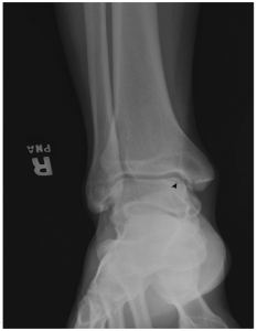 talar dome fracture