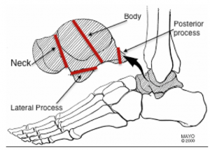 talus injury