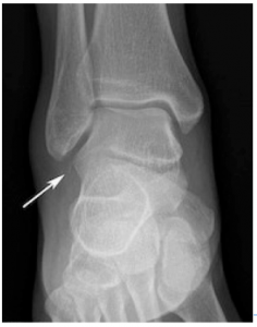 talus lateral process fracture
