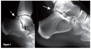 talus posterior process fracture