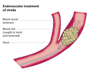 endovascular tx of stroke