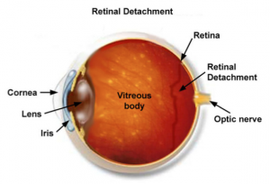 eye retinal detachment