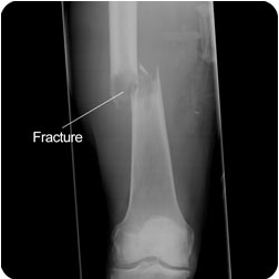 which of the following is a common complication of long bone fractures