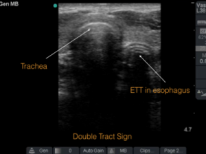 ACEP double tract