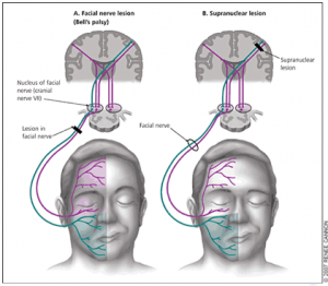 innervation palsy facial upper bell lower nerve motor vs neuron bells lesion paralysis vii face cn umn weakness management muscles