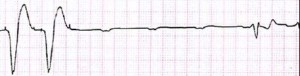 Failure to Pace Output Failure
