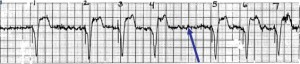 Oversensing