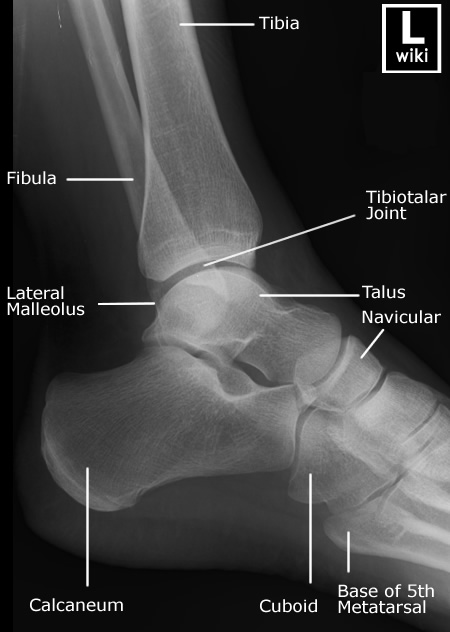 emDOCs.net – Emergency Medicine EducationDiagnostic accuracy of ankle x