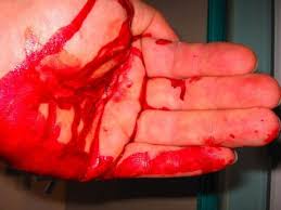 bleeding wounds emdocs