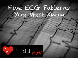 ECG-Patterns-765x575