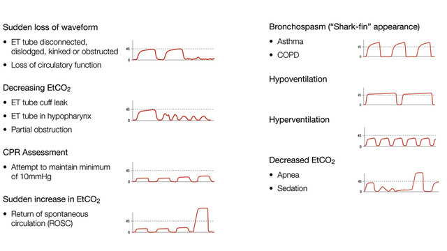 EmDOCs Emergency Medicine EducationInterpreting Waveform EmDOCs Emergency Medicine EducationInterpreting Waveform