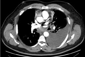 CT chest