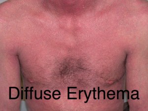 diffuse erythroderma