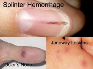Petechiae mild case