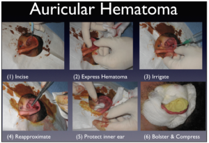 auricular hematoma