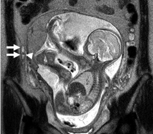 Source: Jang KM et al. The value of 3D T1-weight gradient-echo MR imaging for evaluation of the appendix during pregnancy: preliminary results. Acta Radiol. 2011 Ocr 1; 52(8):825-8.