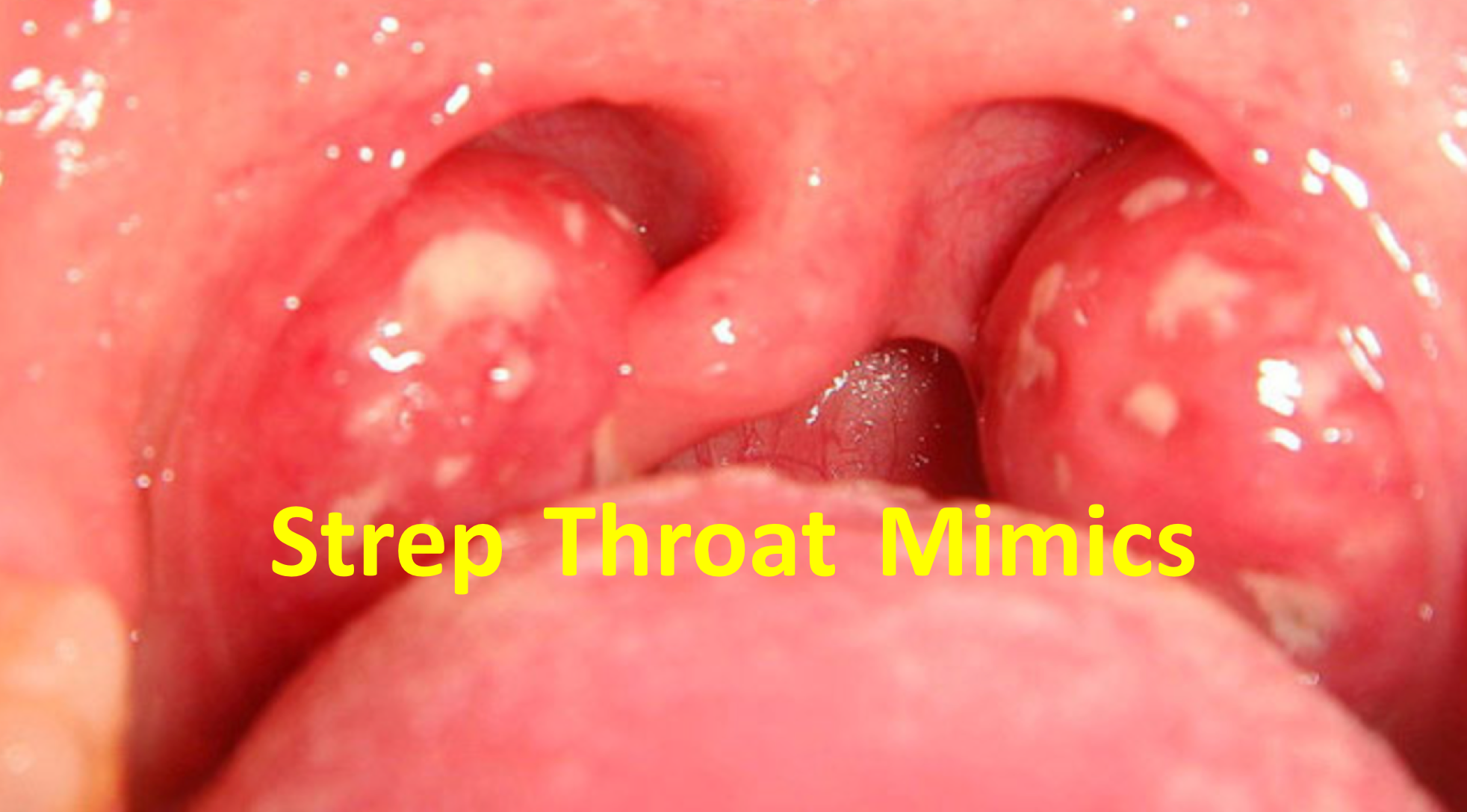 strep throat photos