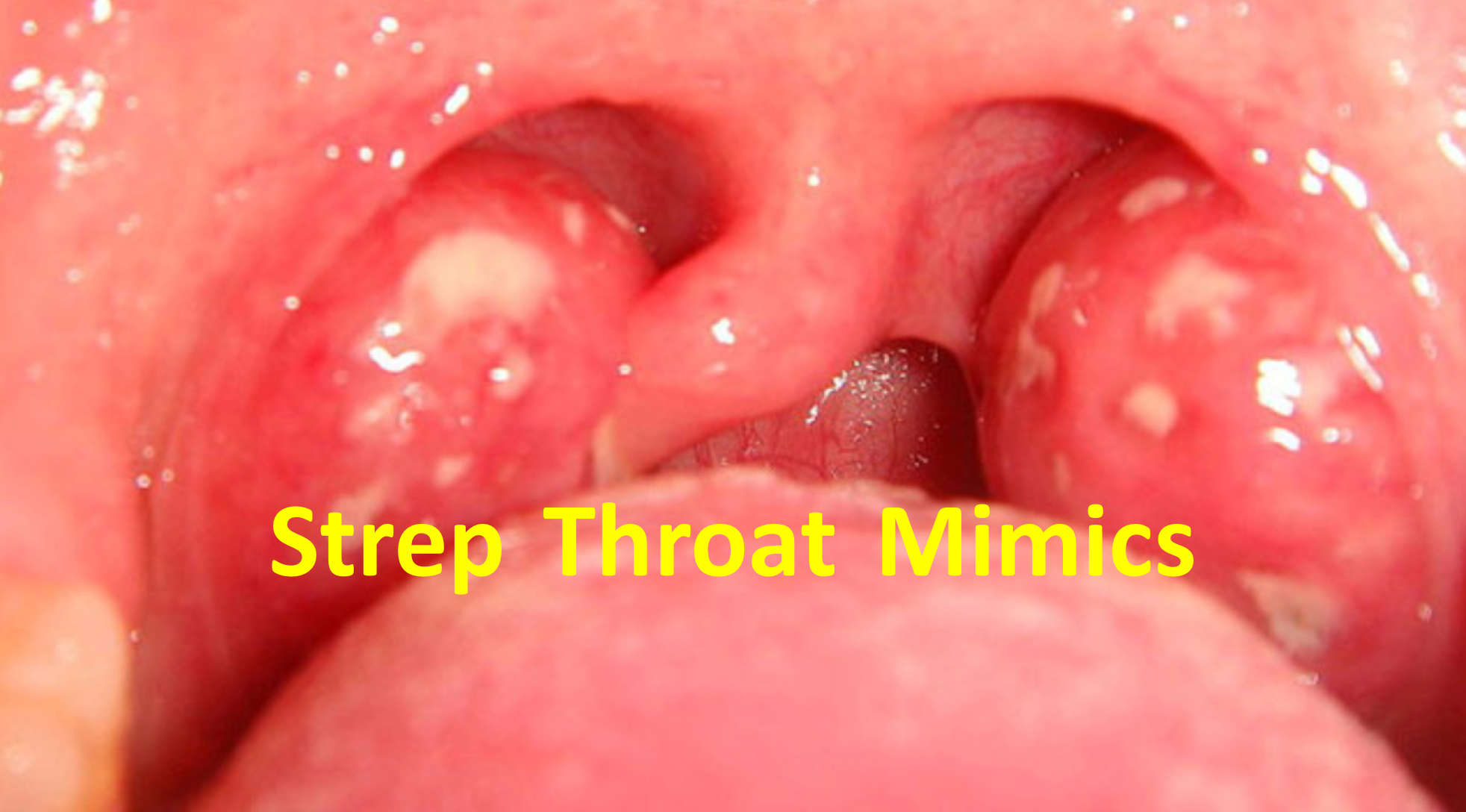 Strept Throat 101