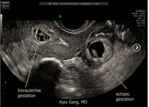 heterotopic