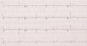 2nd-degree-block-type-2