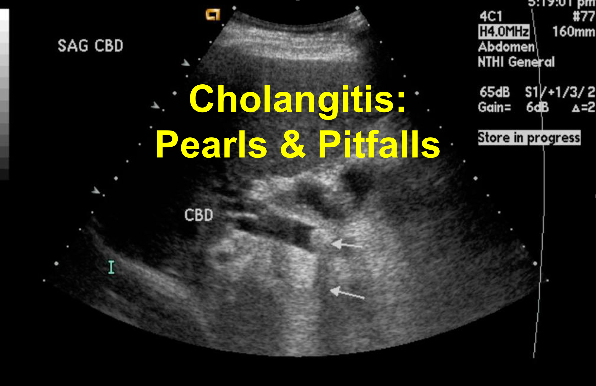 ascending cholangitis management medscape