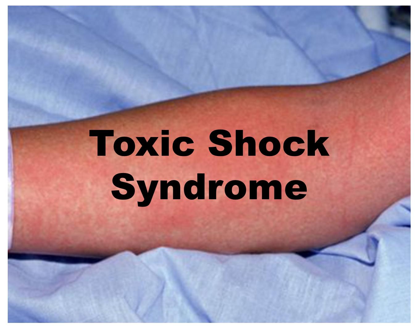 toxic shock syndrome rash images)
