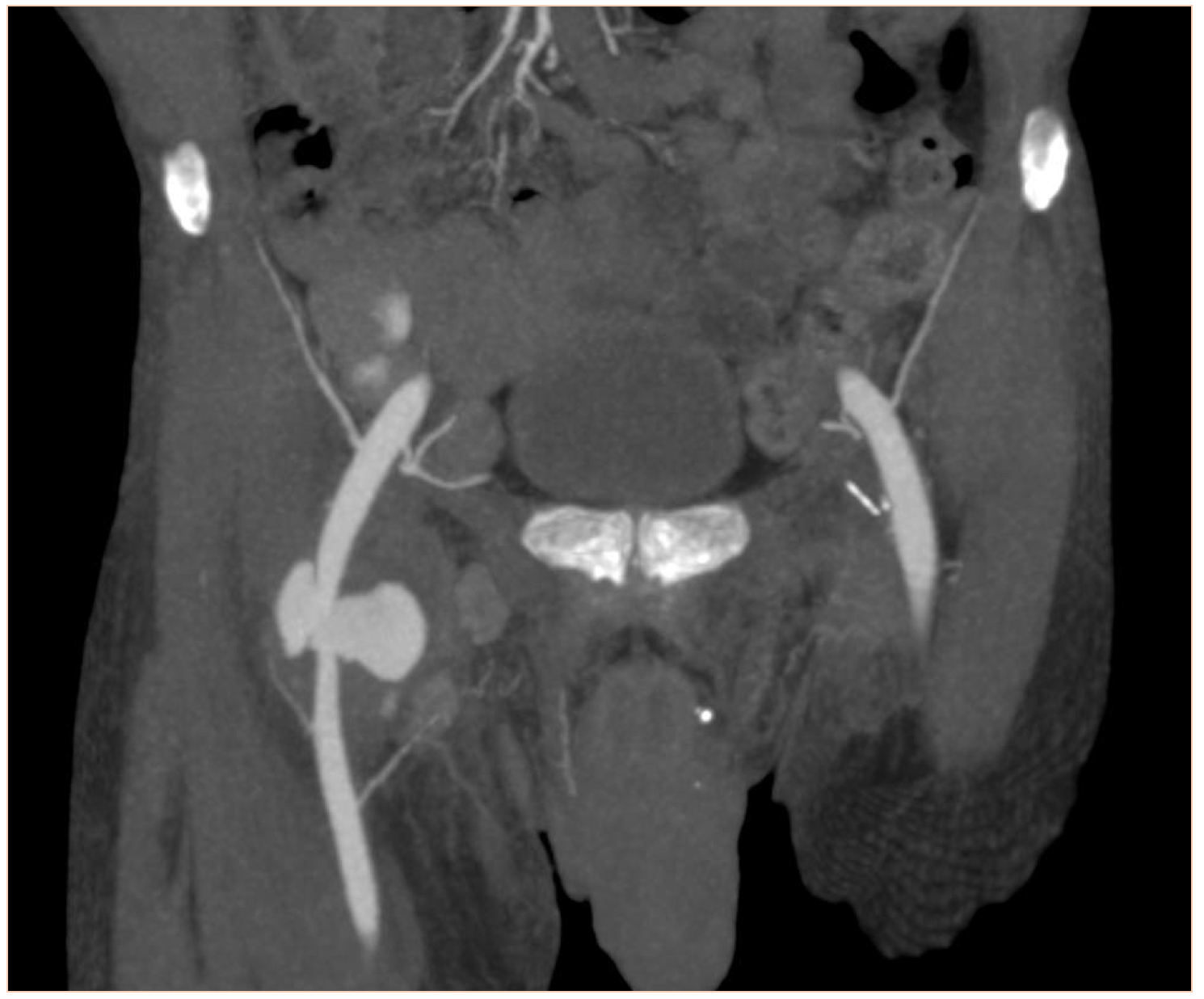 Emergency Medicine Educationa Lump In The Groin The